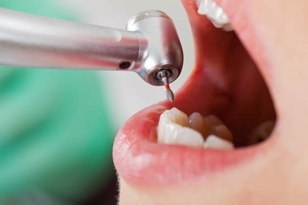 Best Emergency Dentist for Lost Fillings or Crowns in Eastvale, CA